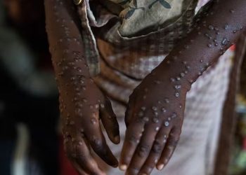 África registra más de 34 mil casos de mpox