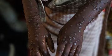 África registra más de 34 mil casos de mpox