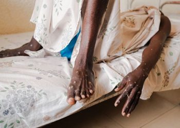 África registra casi 45,330 casos y 1,014 muertes por mpox