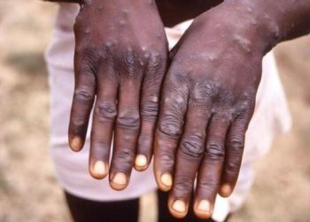 África contabiliza casi 38,300 casos y 979 muertes por mpox