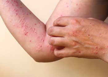 México con 34 muertos y 4 mil 153 casos de Mpox