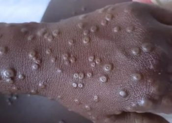 África registra casi 54,000 casos de mpox y 1,109 muertes 