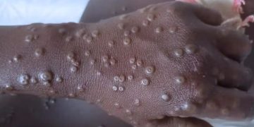 África registra casi 54,000 casos de mpox y 1,109 muertes