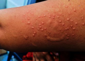 África supera los 50,000 casos de mpox 
