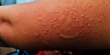África supera los 50,000 casos de mpox