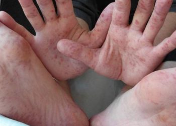 Brote de coxsakie en Hidalgo, supera los 400 casos