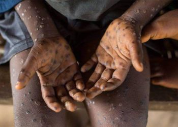 África ha registrado más de 60,000 casos y 1,200 muertes de mpox en 2024