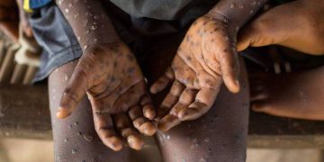 África ha registrado más de 60,000 casos y 1,200 muertes de mpox en 2024