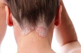 Esperanza para la psoriasis, nuevo fármaco activado por la luz reduce los efectos
