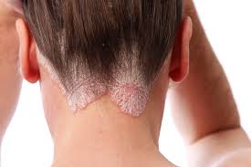 Esperanza para la psoriasis, nuevo fármaco activado por la luz reduce los efectos