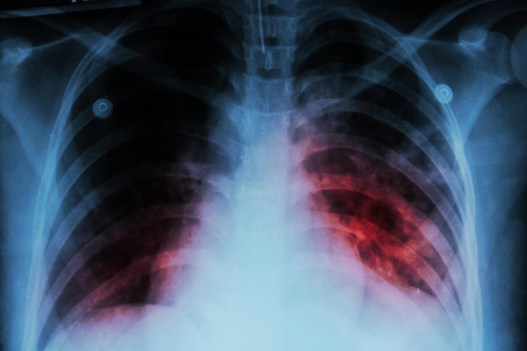 oms alerta por recortes a la tuberculosis