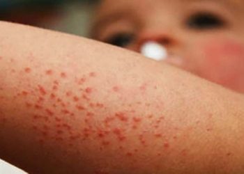 “Niños entre 5 a 9 años los más afectados por contagios de sarampión”: Experto  