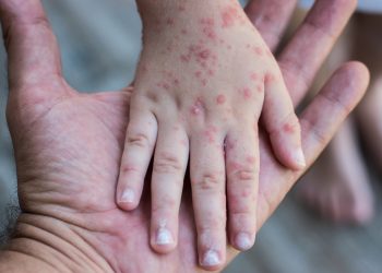 Sonora: Detectan 12 casos sospechosos de sarampión