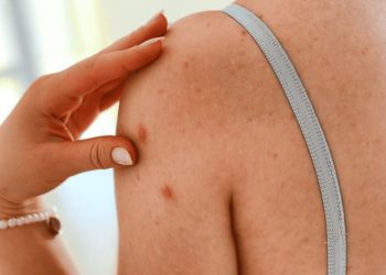 Confirman un caso de sarampión en Sonora