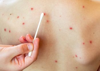 Sonora: Confirman cuatro nuevos casos de sarampión