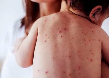 Sonora confirma 17 casos de sarampión