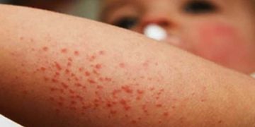 Casos de sarampión están en expansión, alerta SSA