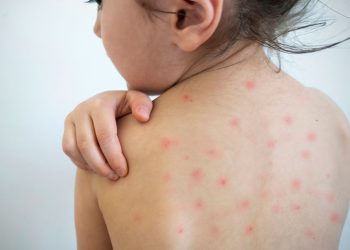 “Vacunas, la mejor opción para evitar contagio de sarampión”: epidemiólogo