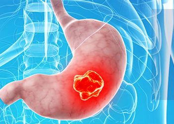 ¿Por qué el cáncer de estómago, como el que padecía Xava Drago, es potencialmente mortal?