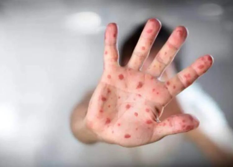 Campaña de vacunación en Sonora ante brote de sarampión