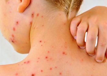 Sarampión en México: Casos caen un 30%, pero lanzan aviso urgente para estas edades