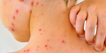 Sarampión en México: Casos caen un 30%, pero lanzan aviso urgente para estas edades