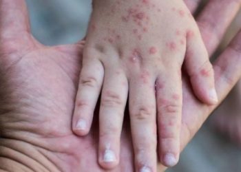 Jalisco suma 122 casos de sarampión y se ubica en segundo lugar a nivel nacional