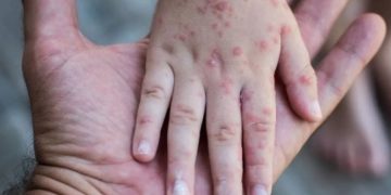 Jalisco suma 122 casos de sarampión y se ubica en segundo lugar a nivel nacional