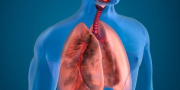 Muertes por tuberculosis bajan 3% pero sigue siendo la infección más mortal