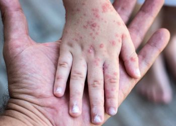 “El riesgo del sarampión es mayor que el riesgo de aplicarse una vacuna”: especialista de la UNAM