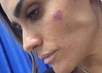 Alessandra Rojo de la Vega muestra las lesiones que sufrió en la Cuauhtémoc