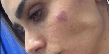 Hay 20 lesionados y 11 denuncias por agresión a Rojo de la Vega