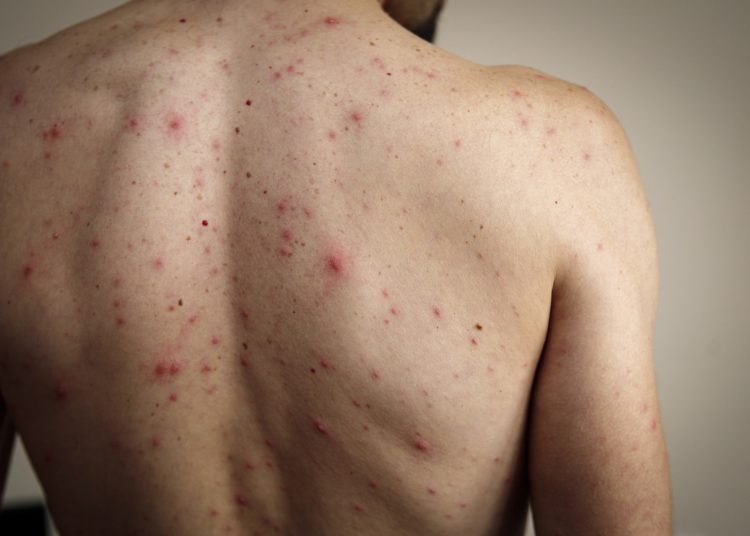 Autoridades de Salud informan sobre el brote de sarampión en México