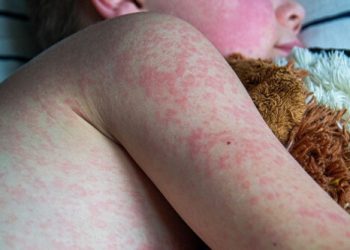 Salud Jalisco prevé lograr el objetivo de vacunación contra sarampión en tres semanas