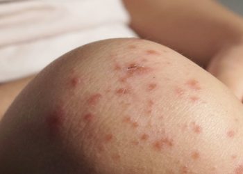 Especialistas recomiendan reforzar esquemas de vacunación ante brotes de sarampión