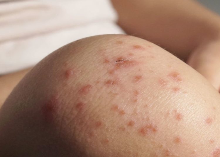Especialistas recomiendan reforzar esquemas de vacunación ante brotes de sarampión