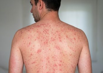 Secretaría de Salud de CDMX reporta 497 casos de Sarampión y un fallecimiento