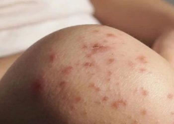 Nadine Gasman informó que se investigan dos muertes más por posible sarampión en la capital