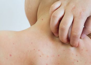 La Secretaría de Salud de la CDMX reportó 576 casos de sarampión en la capital