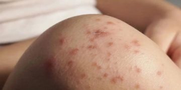 Nadine Gasman informó que se investigan dos muertes más por posible sarampión en la capital