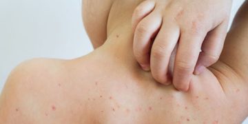 La Secretaría de Salud de la CDMX reportó 576 casos de sarampión en la capital